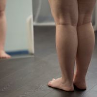 Risiken und Nachbehandlung eines Lipödem-Behandlung