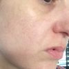 Fadenlifting oder Unterspritzung mit Hyaluron?