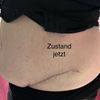 Zweitmeinung zu meiner Bauchdeckenstraffung