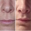 Bullhorn Lip Lift -veränderte Nase?!